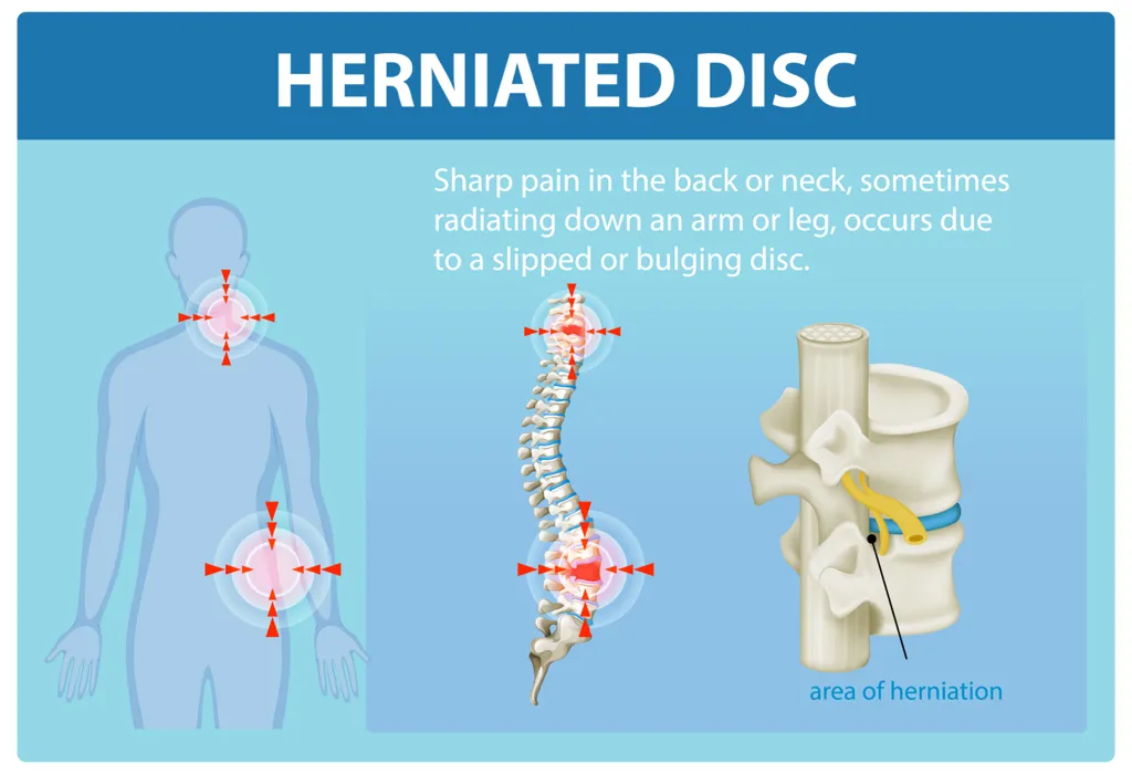 Herniated disc treatment in Granada Hills, CA