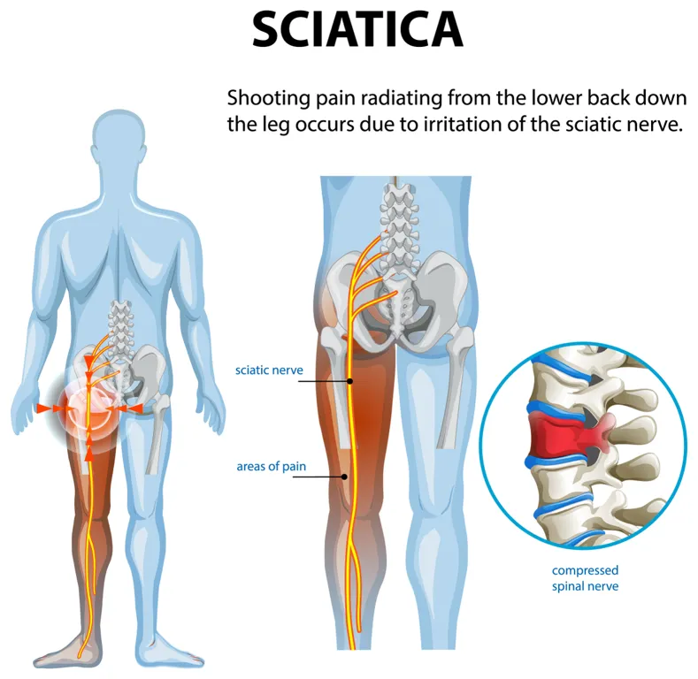 Sciatica treatment in Granada Hills, CA
